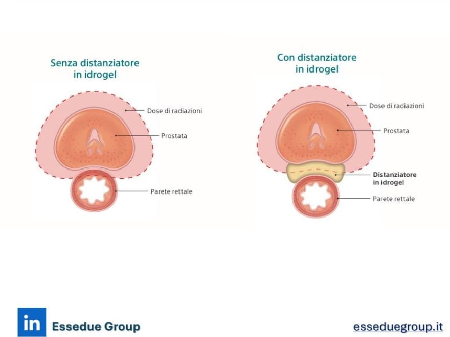 Innovazione e sicurezza con SpaceOAR: una nuova frontiera per il benessere dei pazienti oncologici